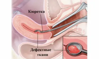 Лечение гинекологических заболеваний в Москве - Лечение воспалительных  процессов в гинекологии в АльтраВита