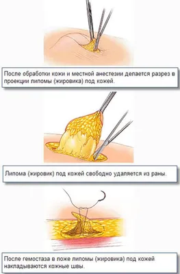 Удаление липом (жировиков), атером и фибром на лице и теле в клинике  лазерной хирургии «Вектор»