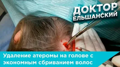 Удаление атеромы (жировика) на голове с экономным сбриванием волос. -  YouTube