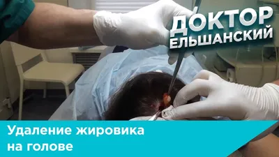 Что такое липома и почему появляется как её лечить - Лазерсвiт