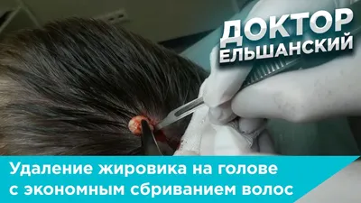 Удаление жировика на голове с экономным сбриванием волос - YouTube