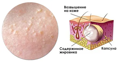 Уход за раной после удаления липомы | Медицинский центр Эра