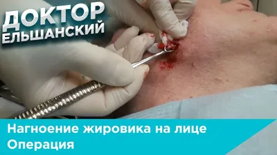 Удаление липомы по низким цены в Москве лазером, хирургическим методом,  криодеструкция и другие