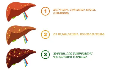 Жировой гепатоз печени - симптомы и лечение - Журнал о Здоровье