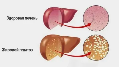 Таблетки при жировом гепатозе печени: список топ-6 средств по версии КП с  отзывами и ценами