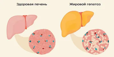 Симптомы жировой печени (жировой гепатоз): вы бы и не подумали, что дело в  печени...😨 - YouTube