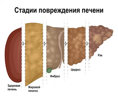 Стеатоз печени