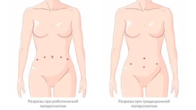 Лапароскопические операции в Китае