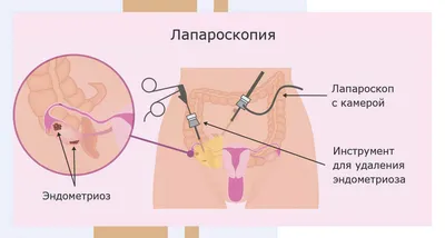 Лапароскопия в гинекологии: нюансы, о которых необходимо знать