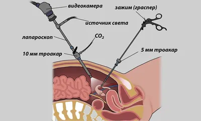 Удаление кисты яичника | CMC Hospital