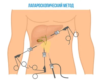 Удаление матки: как проходит операция, виды оперативного вмешательства,  восстановление после