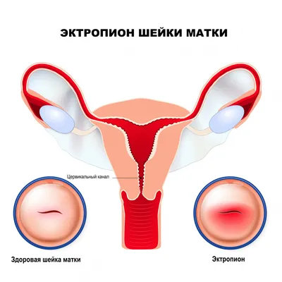 Растянутое\" влагалище у женщин вне возраста | Клиника Бухаровой