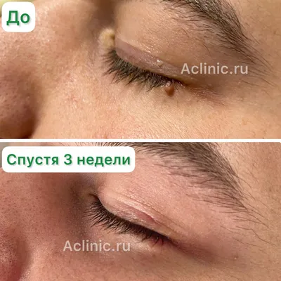 Лазерное удаление кератом: лечение в Киеве | Brenner Clinic