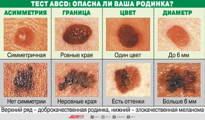 Раз — и в меланомы. Почему многим нельзя загорать и какие родинки опасны? |  Здоровая жизнь | Здоровье | АиФ Аргументы и факты в Беларуси