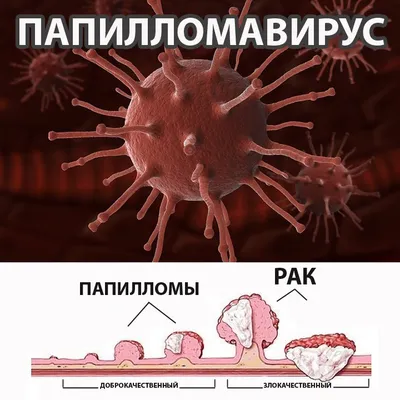 Зачем удалять родинки, бородавки. Какой способ удаления лучше