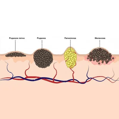 Злокачественные папилломы фото