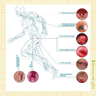 Папилломы - причины, симптомы, диагностика, лечение и профилактика  заболевания