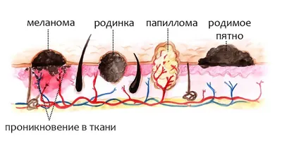 Папилломы – наросты на кожных покровах... - Gainmiga Dushanbe | Facebook