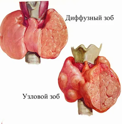 Узловой зоб лечение консультация в экспертной клинике ID-CLINIC  Санкт-Петербург