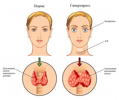 Узловой зоб щитовидной железы. Лечение узлового зоба| MED Expert