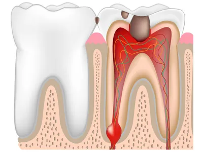 Зубы мудрости - все что нужно знать об этом типе зубов - стоматолог