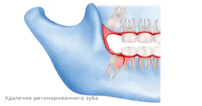 Сломанный зуб (раздробленный). Почему зубы ломаются. Что можно сделать.  Цена.