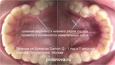 Что делать, если зуб сильно разрушен