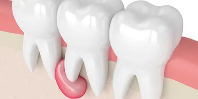 Жевательные зубы: функция, уход и важность посещения дантиста | Информация  о молярах