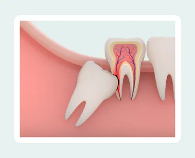 Дистопированный зуб: причины, последствия и лечение