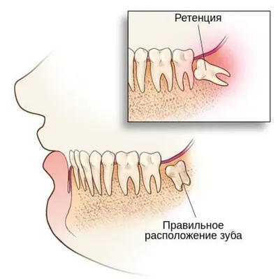 Как вырвать зуб: как проводится процедура удаления коренного зуба врачом в  стоматологии