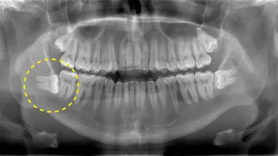 Зубы мудрости: когда и как удаляют, противопоказания