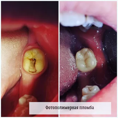 Восстановление зуба мудрости | Стоматология в Запорожье Dental Studio