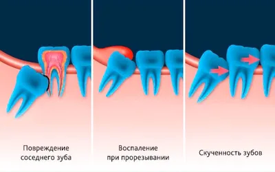 Зубы мудрости - Центр ортодонтии №1