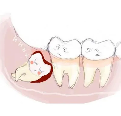 Зуб мудрости» или «восьмой» зуб: лечим или удаляем?
