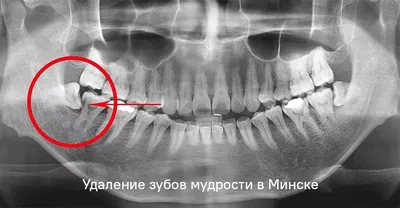 Удаление зубов мудрости (восьмерок) в Минске, доступные цены