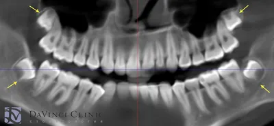 Зубы мудрости – проблемы роста, показания к удалению, рекомендации после  удаления