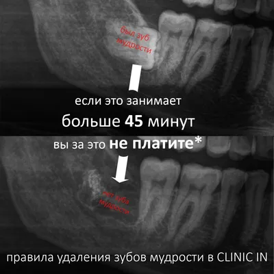 Удаление ретинированного зуба мудрости: цена в Москве на операцию по  удалению непрорезавшегося зуба в клинике