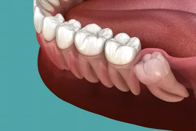 Если не удалить воспаленный зуб мудрости? - Экстрадент