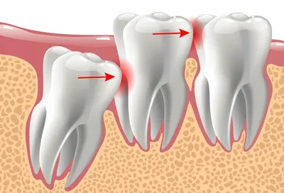 Зуб мудрости растет и болит десна: что делать, как снять боль | Dental Art