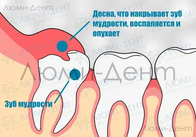 Зуб мудрости: фото как растут зубы мудрости | Гид по Стоматологии