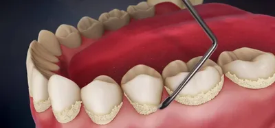 Зубной камень: вопросы и ответы о самом распространенном явлении