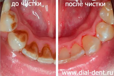 Зубной камень: причины, лечение, профилактика | Как избавиться от зубного  камня