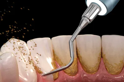 Зубной камень | Методы чистки, показания к удалению | Клиника семейной  стоматологии Дока-Дент