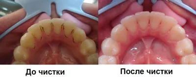 Как удалить зубной камень - методы чистки и профилактики | НАВА