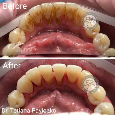 Зубной камень, снятие/удаление. Чистка зубов от камня - в Лобне
