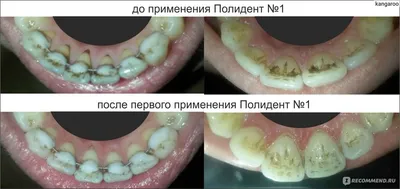 Чистка зубов от камня и налета в Феодосии в стоматологической клинике  «Гармония» недорого