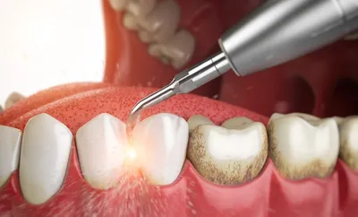 Зубной камень безболезненное удаление чистка ультразвуком в Севастополе |  Стоматология Жемчуг