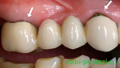 Бюгельный протез зубов — что это такое, виды, фото и уход за бюгельными  зубными протезами