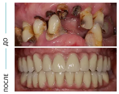 Осложнения после несъемного протезирования зубов в стоматологии