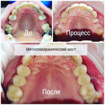 Зубной мост [поставить на 2, 3, 4 зуба цена, фото до и после]